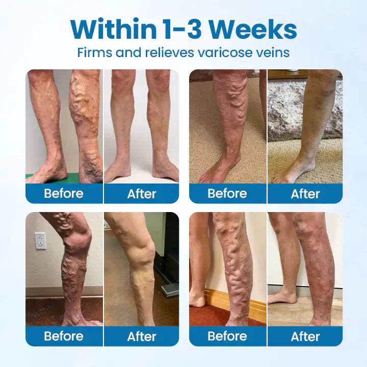 VeinGuard Herbal Spray-✅ Clinically proven to eliminate varicose veins in just 7 days!